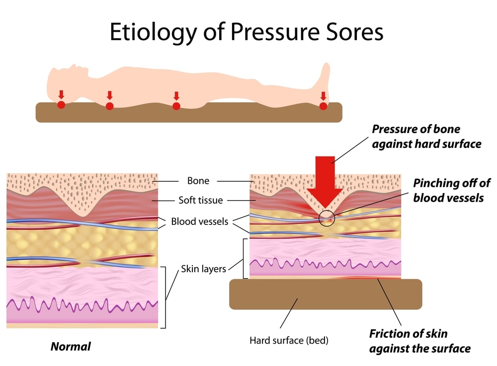 Read more about the article Pressure Sores in Elderly Patients – Understanding the Issue